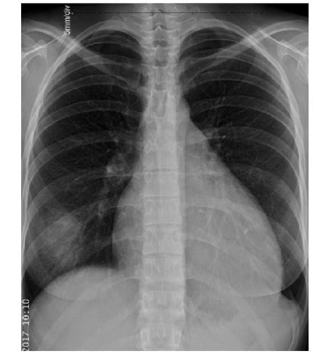 Chest X Ray Shows A Globular Enlargement Of The Cardiac Shadow