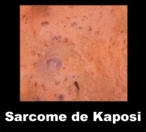 Image Photo Sarcome De Kaposi 2 Dermatologie Vulgaris Médical