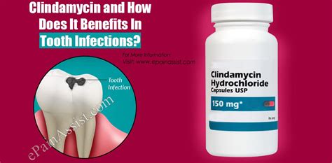 Clindamycin For Tooth Infections
