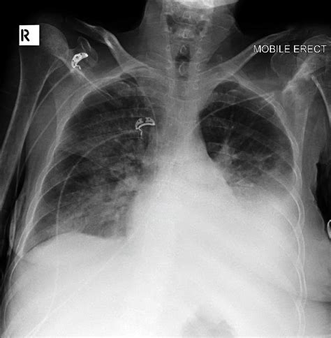 Picc Line X Ray