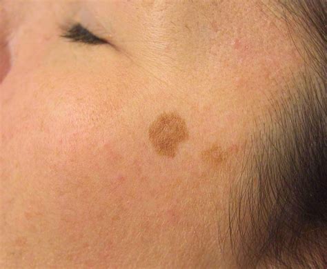 6 Bizarre Skin Spots Explained Integrity Paramedical Skin Practitioners