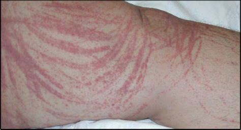 Figure 1 From Shiitake Dermatitis A Report Of 3 Cases And Review Of