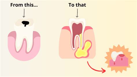 The Stages Of A Gum Abscess And Its Healing Process
