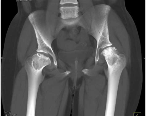 Avascular Necrosis Avn In Patient With Hip And Acetabular Deformities