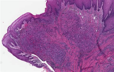 Pathology Outlines Peripheral Giant Cell Granuloma