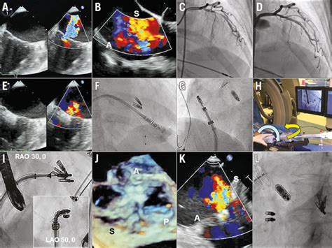 First Percutaneous Micra Leadless Pacemaker Implantation And Tricuspid