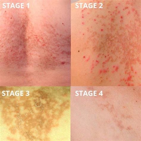 Learn Why Keto Rash Happens And 8 Ways You May Combat It