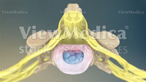 Viewmedica Stock Art Degenerative Disc In Cervical Spine