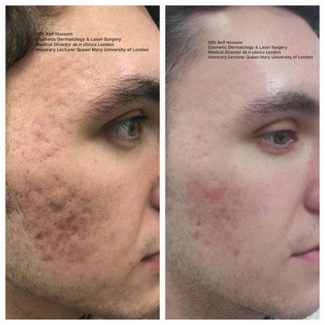 Mothlhtqqjbpqdp Co2 Laser For Acne Scars Before And After