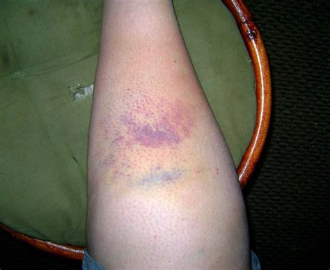 Epic Bruise Is Epic Leg Bruise 2 This Thing Is Better Tha Flickr