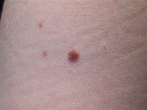 Dry Scaly Moles Tips And Tricks From Doctors