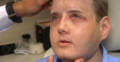 face transplant recipient thriving one year after surgery videos cbs news