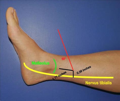 The Percutaneous Posterior Tibial Nerve Stimulation Point Download Scientific Diagram