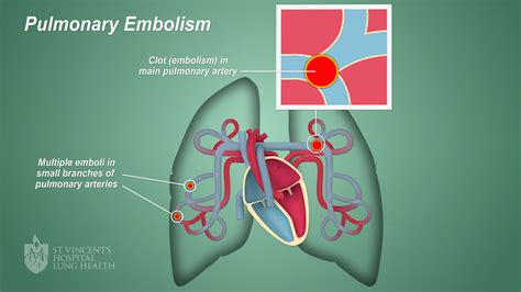 Pe Pulmonary Embolism St Vincents Lung Health