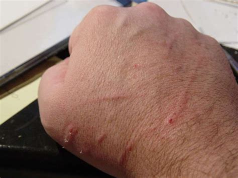 โรค Cat Scratch Disease