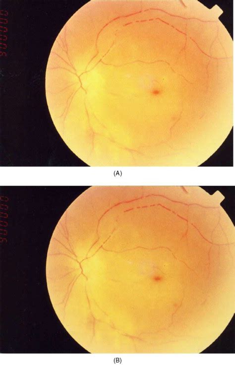 Permanent Vision Loss In One Eye Following Administration Of Local