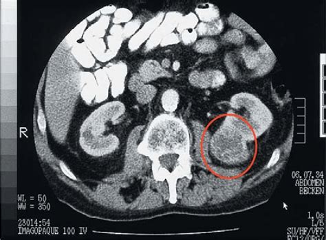 Abdominal Ct Scan Revealing A Peripheral Tumor In The Left Kidney Of