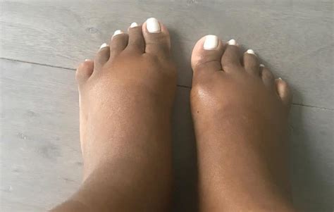 Swollen Feet After Delivery Symptoms Matilde Easton