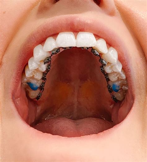 The Ultimate Guide To Adult Braces Sturgill Orthodontics