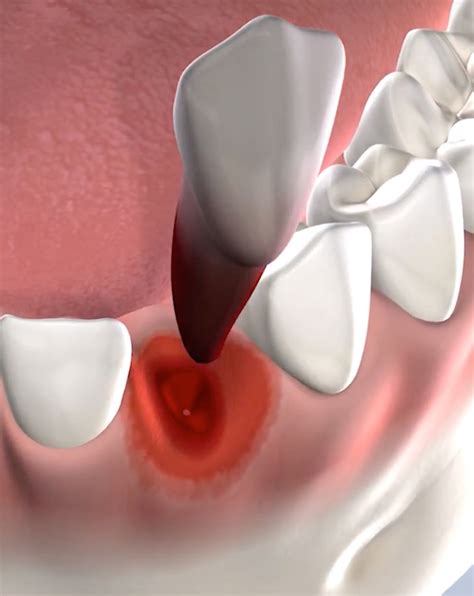 Tooth Extraction In Sonoma And Napa Ca Napa Sonoma Oral Surgery