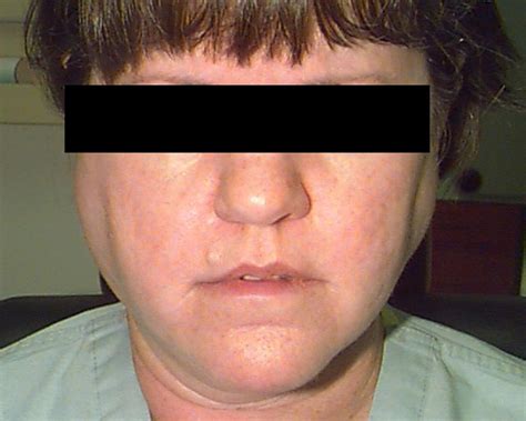 Salivary Glands Sarcoidosis Operative Techniques In Otolaryngology