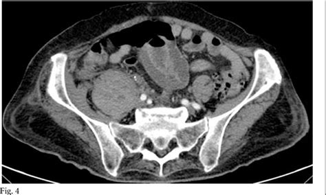 Figure 1 From Iliopsoas Hematoma After Total Hip Arthroplasty Using A