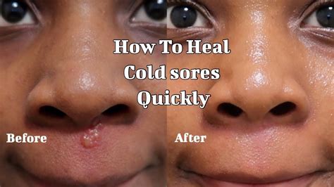 Pin On Treat Cold Sores