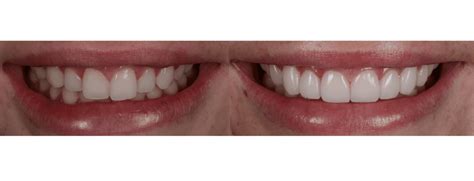 A Briter Smile Cosmetic Dentistry Highland Park Los Angeles Ca