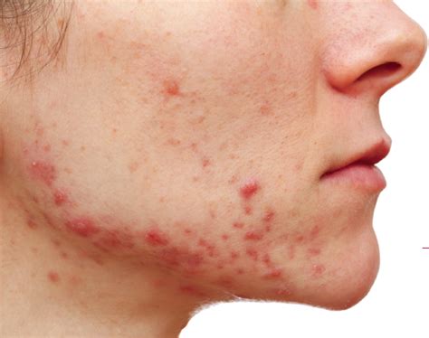 What Is Adult Acne And How To Treat It Dr Health Clinic