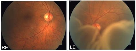 Fundus Photograph Of Re Showing Mild Npdr And Le Showing Extensive