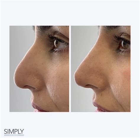 Nose Fillers Chelsea Simply Clinics