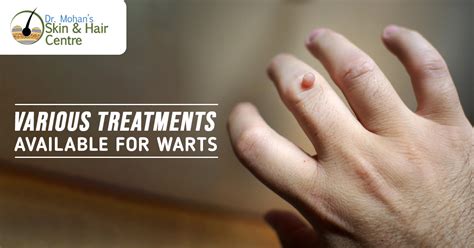 Various Treatments Available For Warts