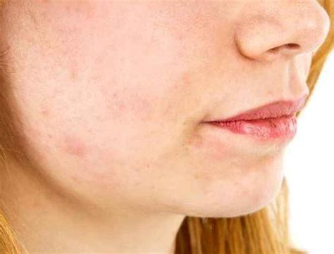Swollen Cheek Symptoms Causes Treatment Pictures