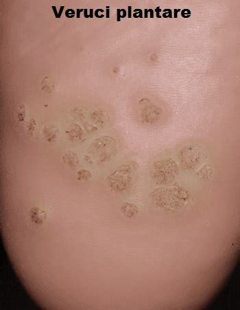 Papilloma Virus Verruca Negii Sau Verucile De Ce Apar Si Cum Se My