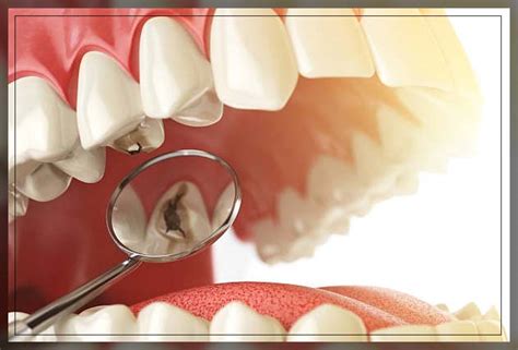 Dental Caries Treatments Signs And Symptoms Repc