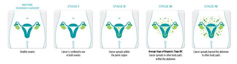 Types And Stages