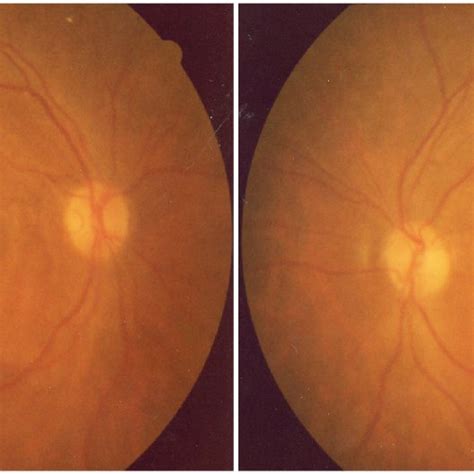 Bilateral Perimacular Flecks With Serous Retinal Detachment Were Shown