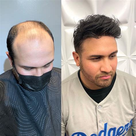 Hair System Reviewamazing Before And After Wearing Livivid Toupee In