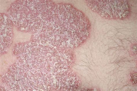Efficacy Of Tildrakizumab In Treating Moderate To Severe Plaque Psoriasis Examined Dermatology