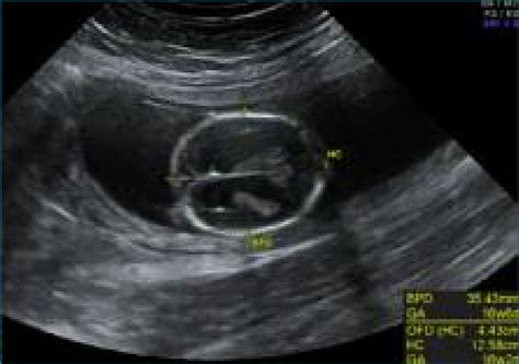 Transventricular View Of Foetal Cranium At 17 Weeks Gestation