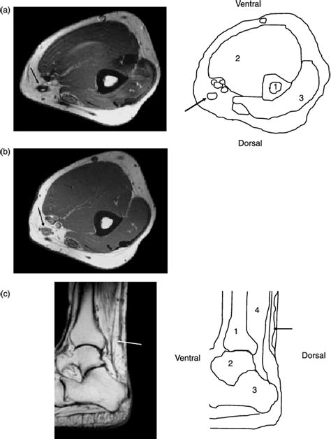 A And B Mri Axial T1 Weighted Images Of The Upper Arm Before Left