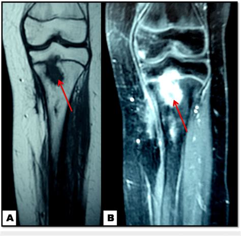 Knee Mri Osteomyelitis Of The Proximal Tibia Red Arrows At Six
