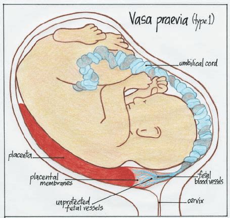 Typically, painless vaginal bleeding with bright red blood occurs after 20. Illustration of vasa praevia type 1. | Download Scientific ...