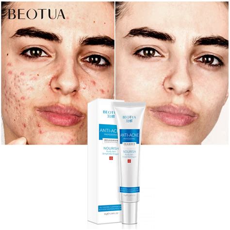 BEOTUA Aloe Acne Face Cream Treatment Anti Acne Scar Day Cream Collagen Shrink Pores Oil Control