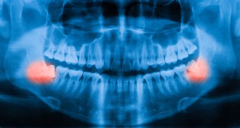 How Do Wisdom Teeth Work Fairfield Dental Arts