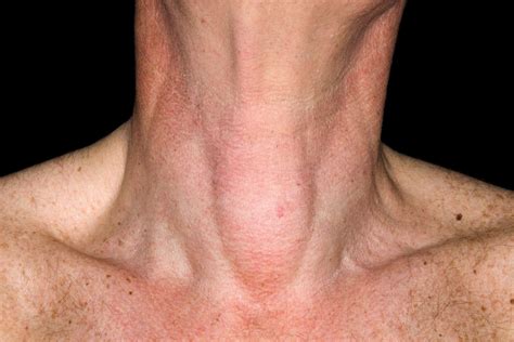 Top Ten Tips For Neck Lumps Pulse Today