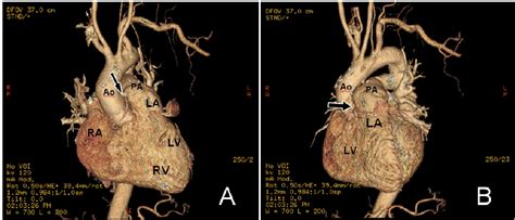 3d Reconstructed Ct Angiogram Of The First Case Arrow Pointing To The