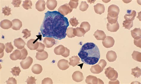 Reactive Lymphocytes Cells And Smears