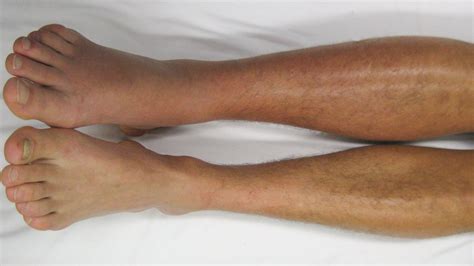 Tormento Maduro Llorar Symptoms Of Blood Clot In Leg After Injury A