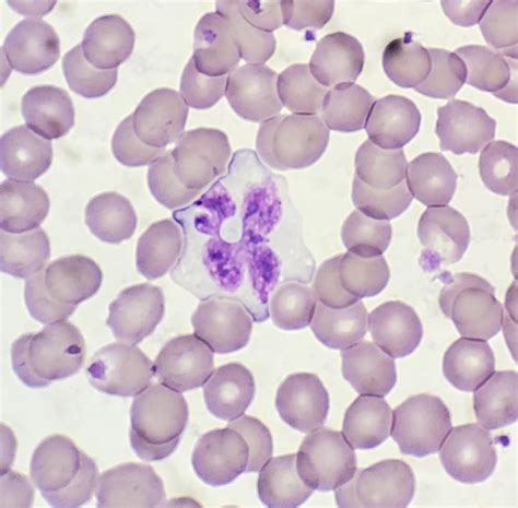 Saw These On A Smear Today Interesting Atypical Lymphs Never Seen The